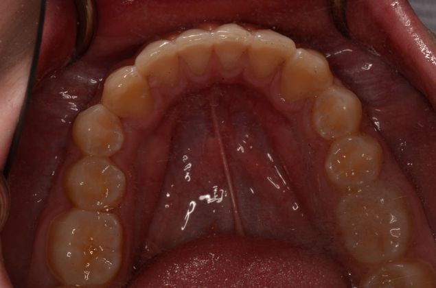 Invisalign: Case 13 - After correction of lower teeth with Invisalign