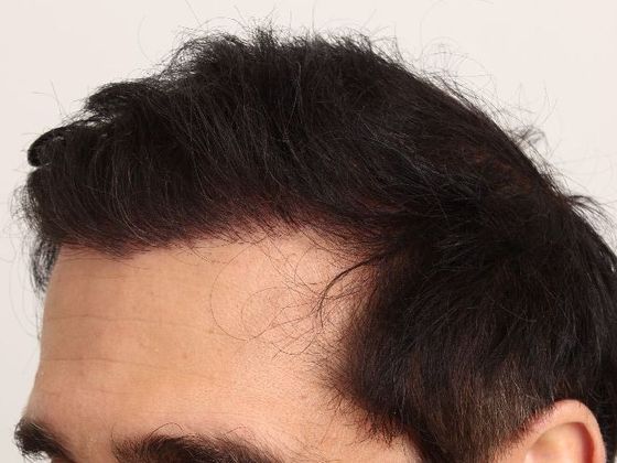 Hair Transplant - Male: Hair Transplant Repair - Case 52 - Hair transplant revised after ultra-refined FUT