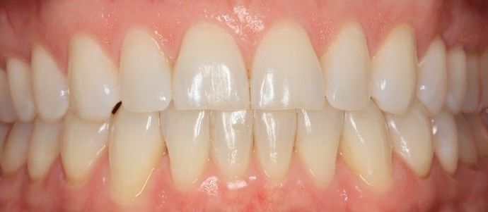 Bonding Case 2 - Before