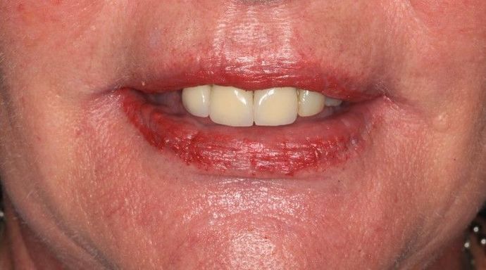 Dental Implants Case 3 - Before