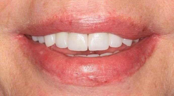 Dental Implants Case 3 - After