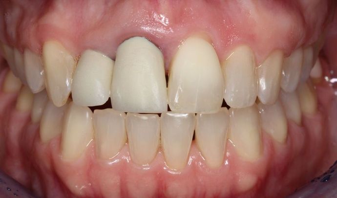 Dental Implants Case 6 - Before