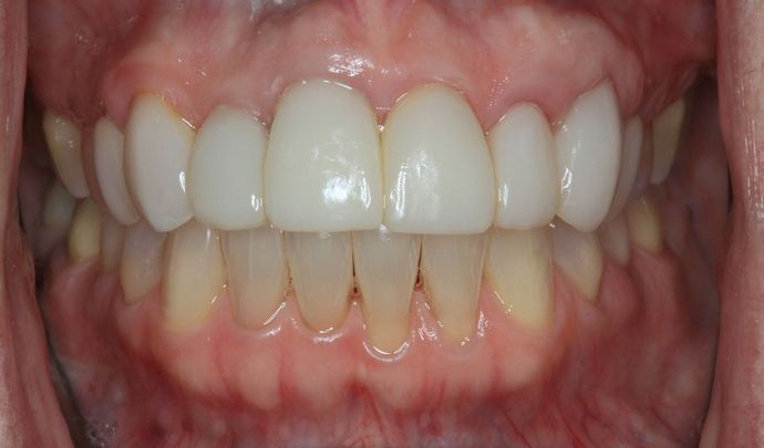 Dental Implants Case 6 - After