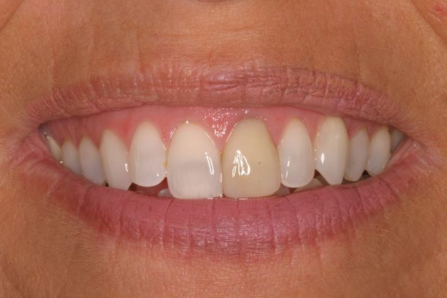 Porcelain Crowns Case 5 - Before