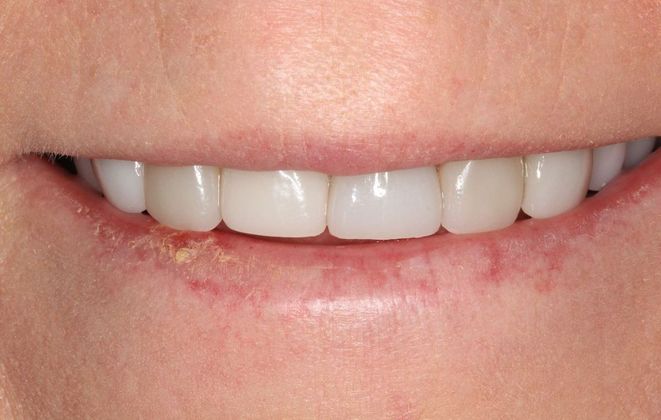 Full Mouth Reconstruction: Case 1 - Before