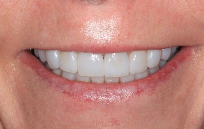 Full Mouth Reconstruction Case 1 - After