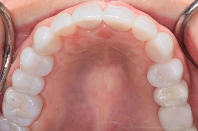 After a Full Mouth Reconstruction