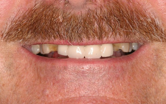 Full Mouth Reconstruction: Case 2 - Before