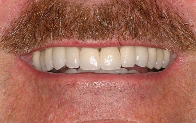 Full Mouth Reconstruction: Case 2 - After