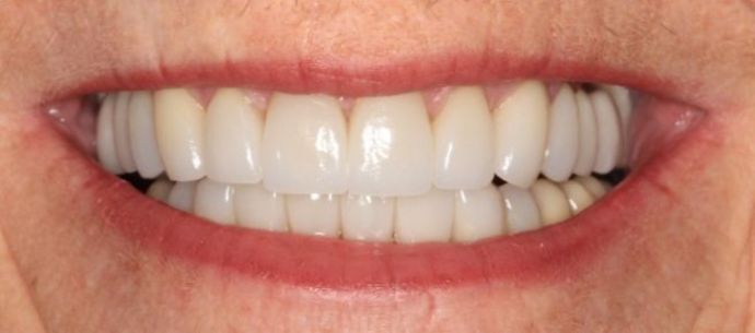 Full Mouth Reconstruction: Case 5 - After