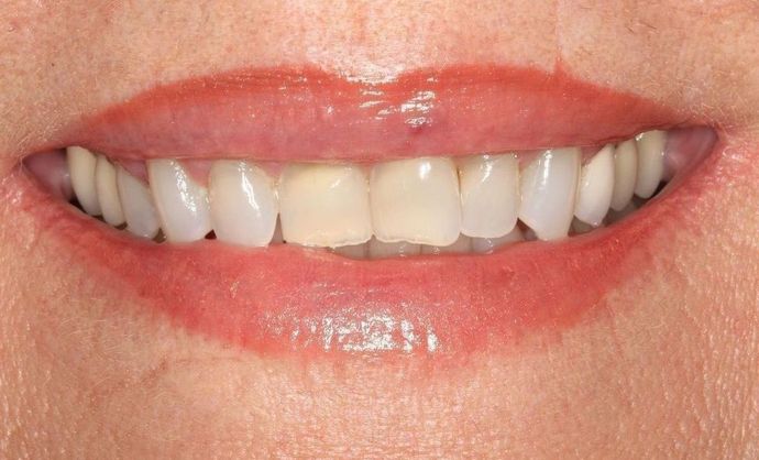 Full Mouth Reconstruction: Case 6 - Before