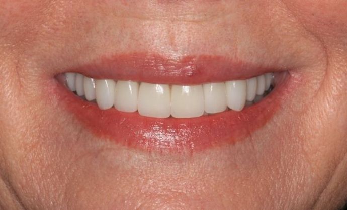 Full Mouth Reconstruction: Case 6 - After