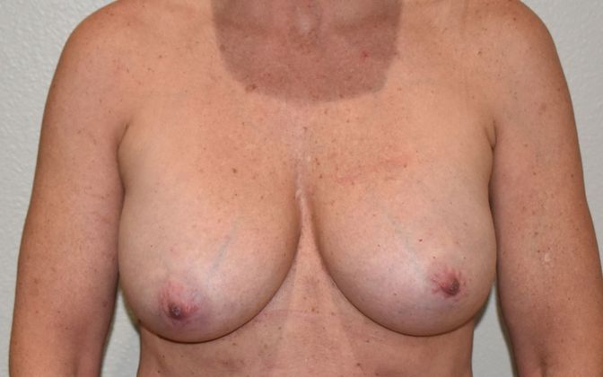 Breast Augmentation w/ Lift: Case 336 - Before