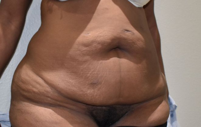 Tummy Tuck (Abdominoplasty): Case 249 - Before