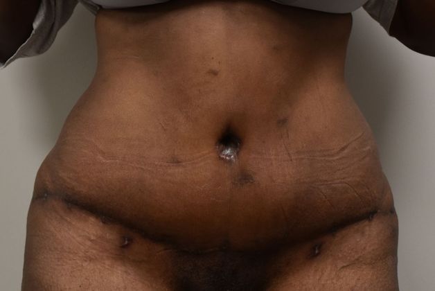 Tummy Tuck (Abdominoplasty): Case 249 - After