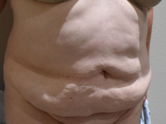 Tummy Tuck (Abdominoplasty): Case 250 - Before