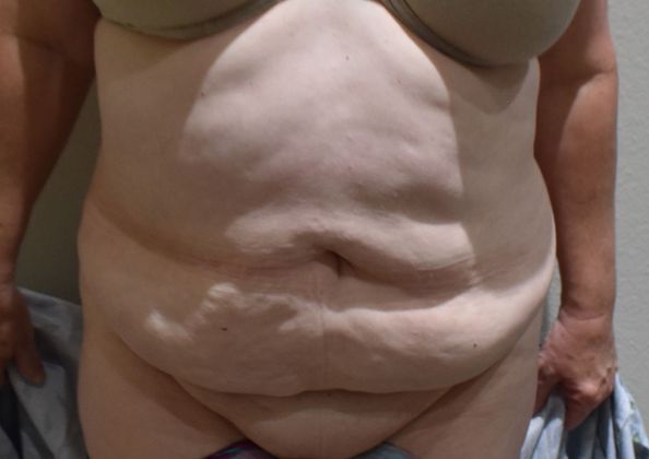 Tummy Tuck (Abdominoplasty): Case 250 - Before
