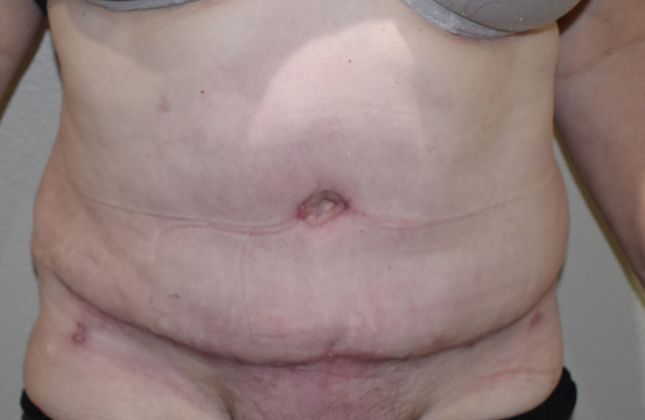Tummy Tuck (Abdominoplasty): Case 250 - After