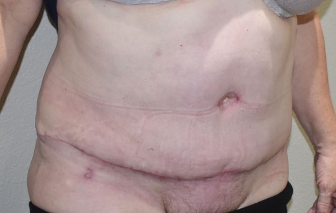 Tummy Tuck (Abdominoplasty): Case 250 - After