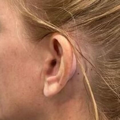 Otoplasty Case 9 - Adult Otoplasty, Darien - Before