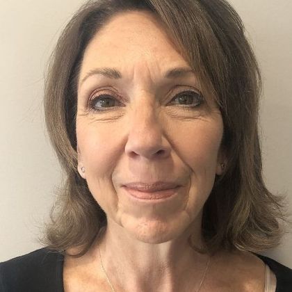 Facelift: Case 25 - Facelift, New Canaan, CT - Before