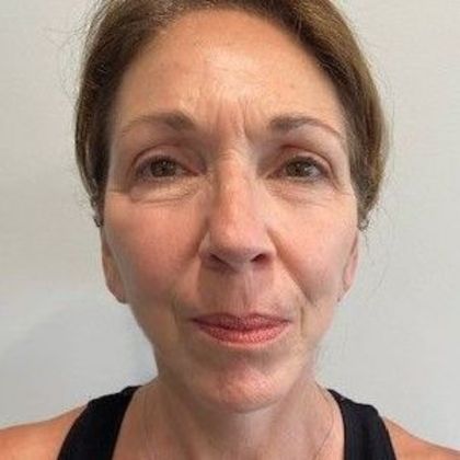 Facelift: Case 25 - Facelift, New Canaan, CT - After