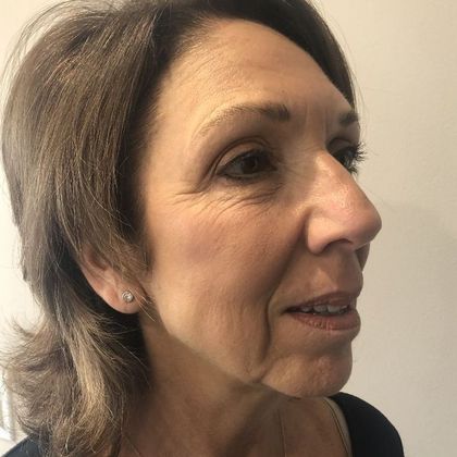 Facelift: Case 25 - Facelift, New Canaan, CT - Before