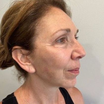 Facelift: Case 25 - Facelift, New Canaan, CT - After