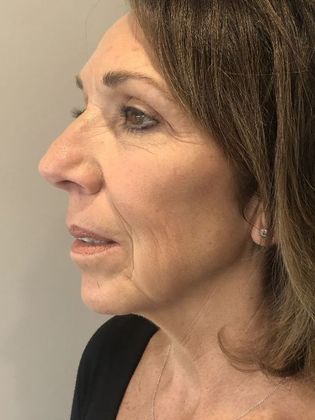 Facelift: Case 25 - Facelift, New Canaan, CT - Before