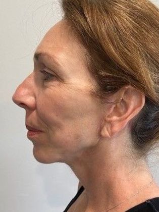 Facelift: Case 25 - Facelift, New Canaan, CT - After
