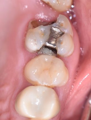 Crowns Case 11 - Victoria, TX - Before