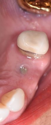 Dental Implants: Case 5 - Halletsville, TX - Before 1247