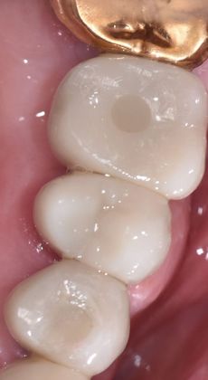 Dental Implants: Case 5 - Halletsville, TX - After