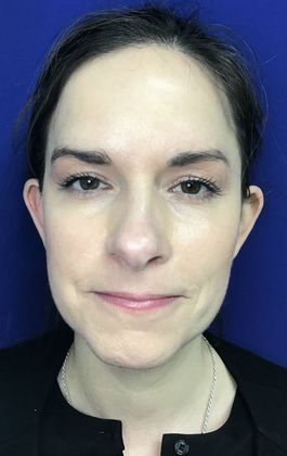 Ear Correction / Otoplasty Case 3 (22703) - Before