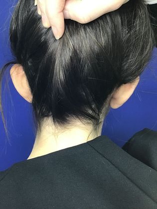 Ear Correction / Otoplasty: Case 3 (22703) - Before