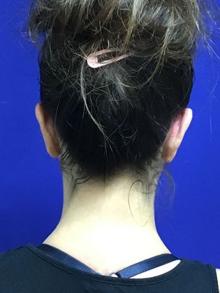 Ear Correction / Otoplasty: Case 3 (22703) - After
