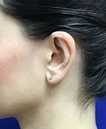 Ear Correction / Otoplasty: Case 3 (22703) - After