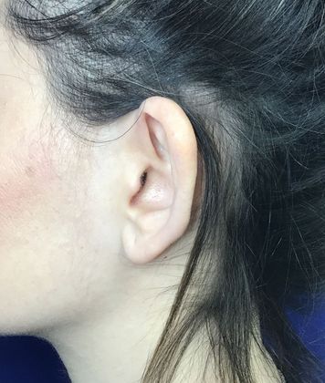 Ear Correction / Otoplasty: Case 3 (22703) - After