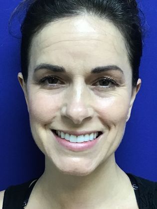 Ear Correction / Otoplasty Case 3 (22703) - After