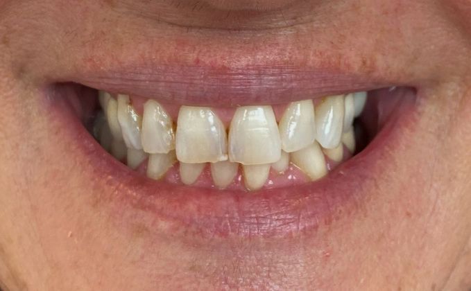 Veneers and Crowns: Case 4 - Before