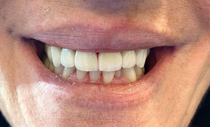 Veneers and Crowns: Case 4 - After