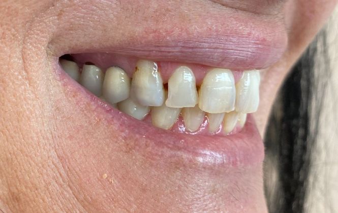 Veneers and Crowns: Case 4 - Before