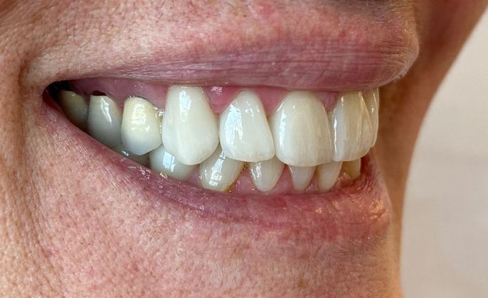 Veneers and Crowns: Case 4 - After