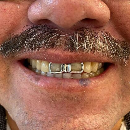 Veneers and Crowns: Case 5 - Before