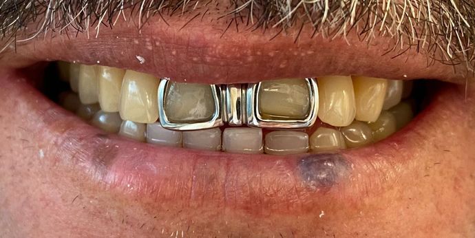 Veneers and Crowns: Case 5 - Before