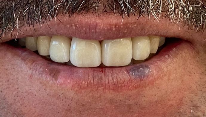 Veneers and Crowns: Case 5 - After