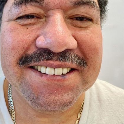 Veneers and Crowns: Case 5 - After