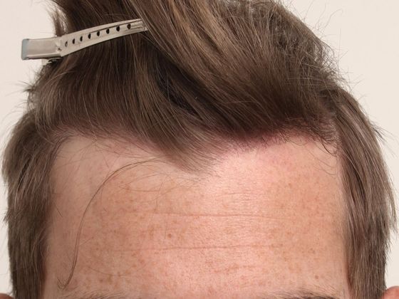 Male Before And After Hair Transplant Photos Hairline FUE (11) - After