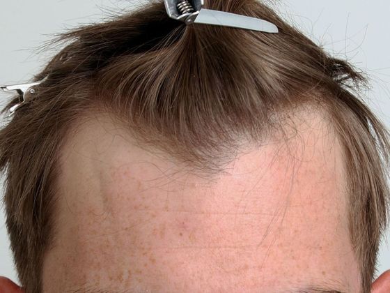 Male Before And After Hair Transplant Photos Hairline FUE (11) - Before
