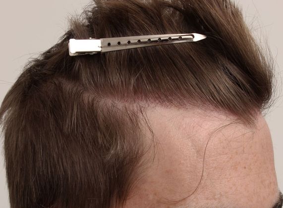 Hair Transplant - Male: Hairline FUE - Case 11 - After FUE hair transplant